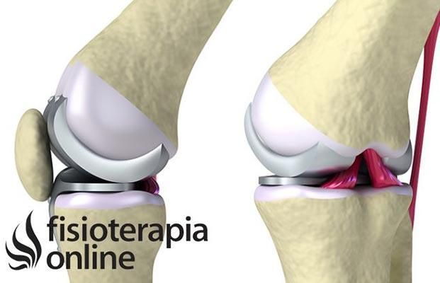 DR JORGE DE LA VEGA - ARTROSCOPIA DE RODILLA