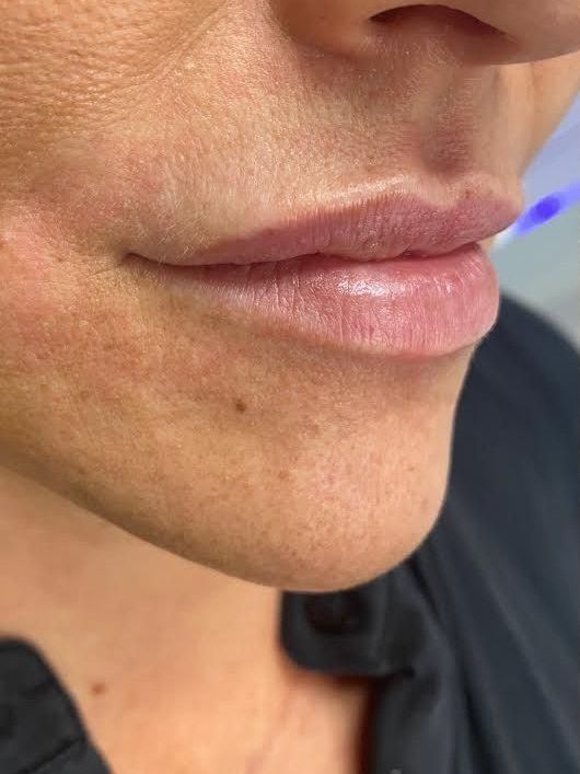 Close-up of a person’s lower face with natural lips and chin in soft lighting