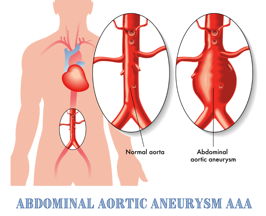 Sunrise Hospital. A woman died from an abdominal aortic aneurysm because Sunrise Hospital kept canceling her surgery. Sunrise Hospital. A woman died from an abdominal aortic aneurysm because Sunrise Hospital kept canceling her surgery.