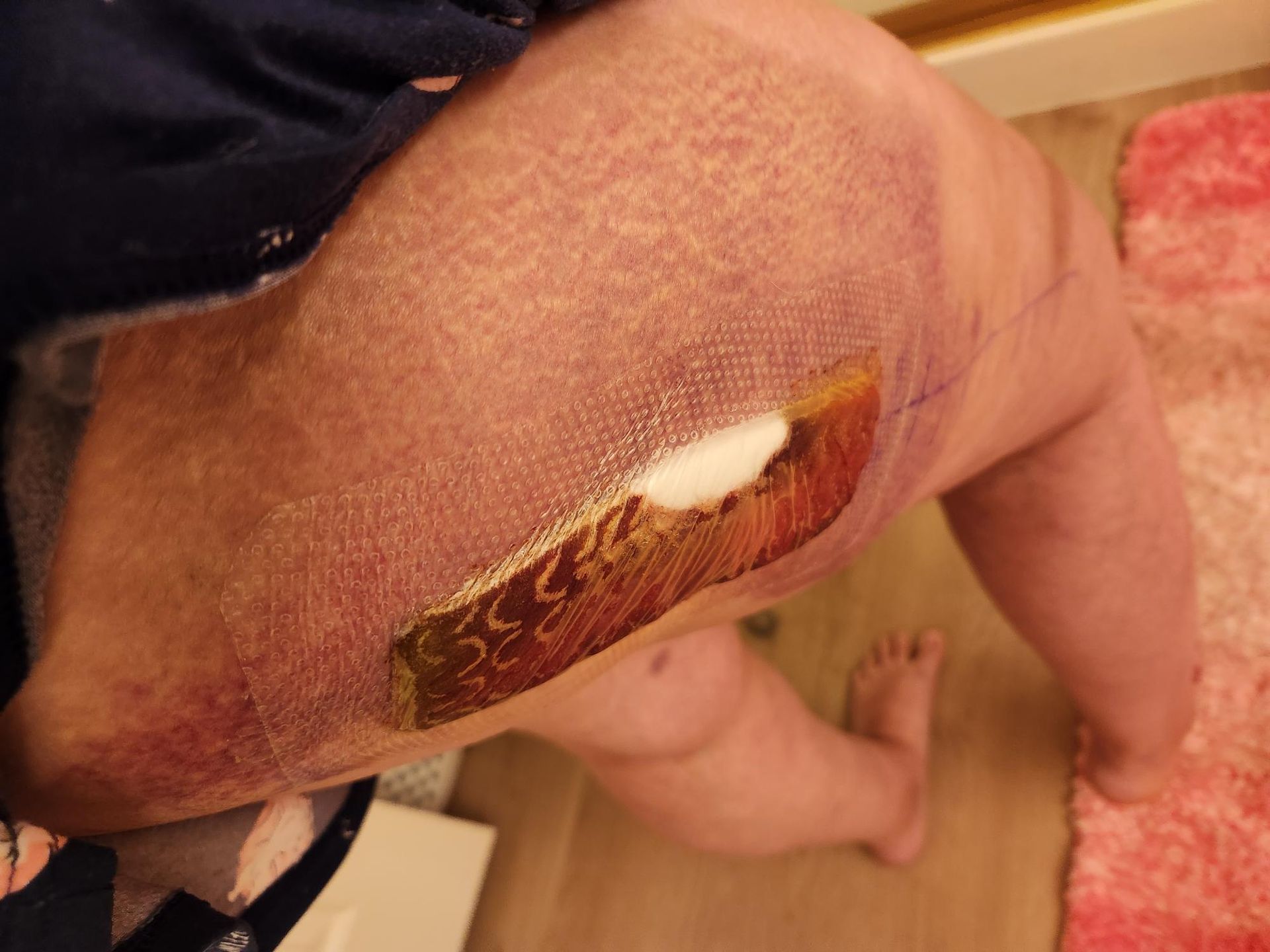 Sunrise Hospital and Dr Michael Bradford-botched hip replacement-pic 1