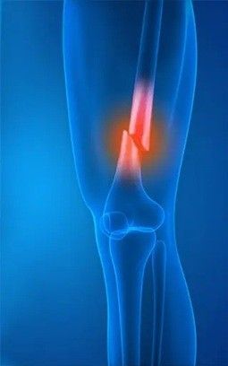 Sunrise Hospital. Stock photo of distal femur fracture.
