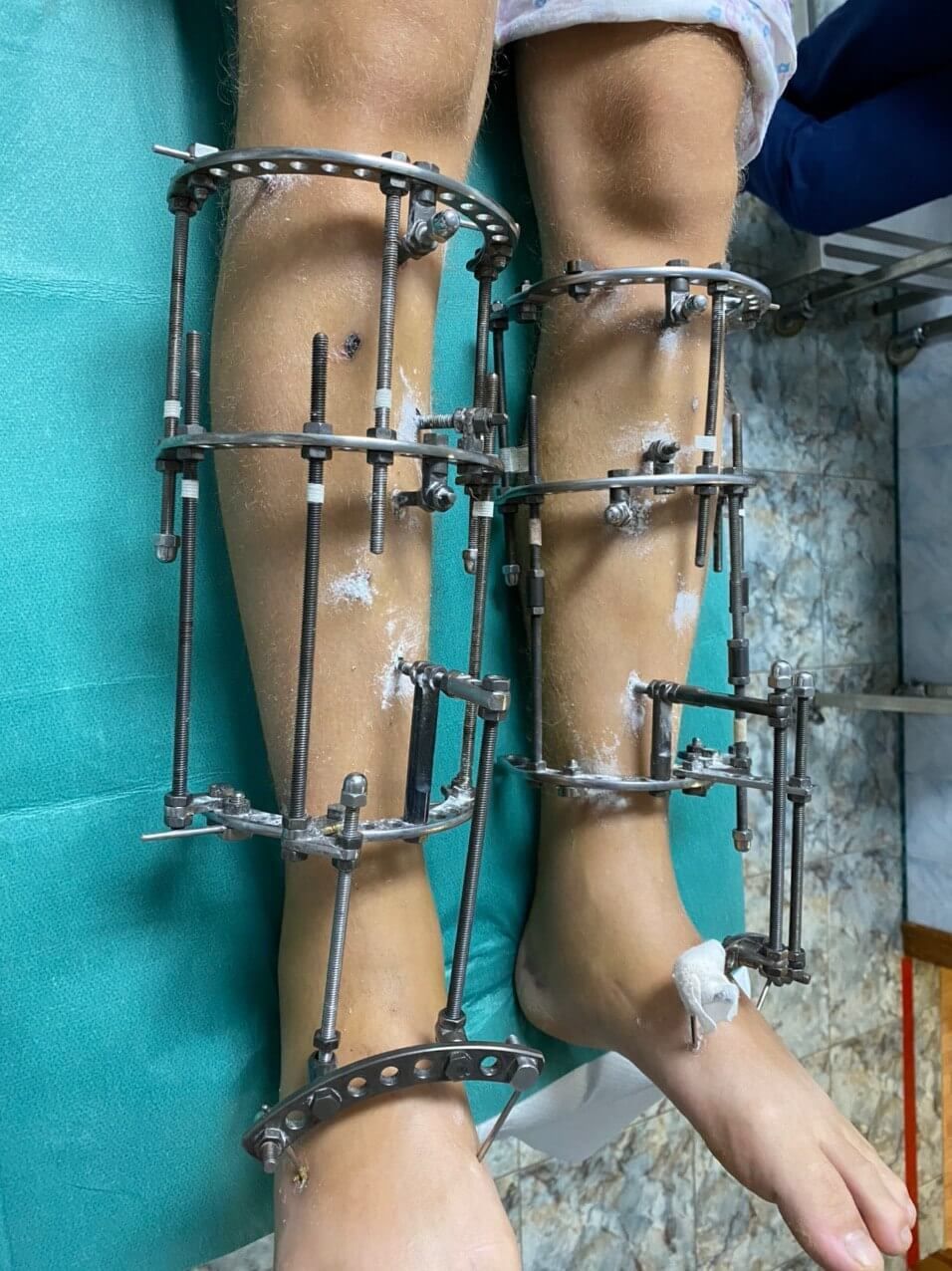 Sunrise Hospital. Patient-111. Stock photo of a man who had leg lengthening surgery. Sunrise Hospital. Patient-111. Stock photo of a man who had leg lengthening surgery.