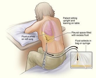 Sunrise Hospital, Patient-147, had fluid drained from her lungs