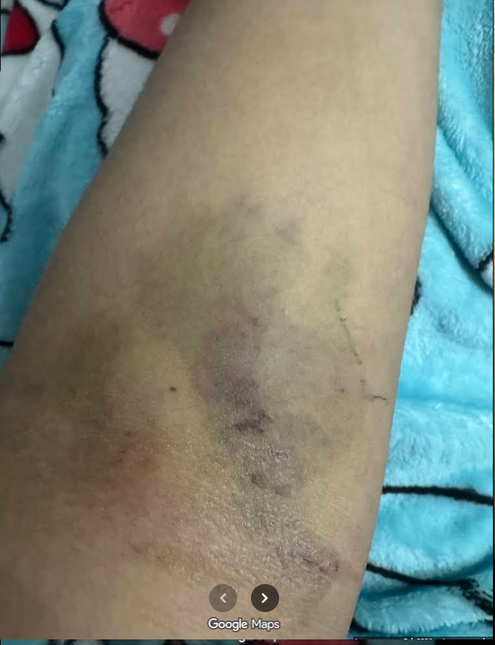Sunrise Hospital, photo of Patient-184's damaged arm due to bad placement of IVs Sunrise Hospital, photo of Patient-184's damaged arm due to bad placement of IVs