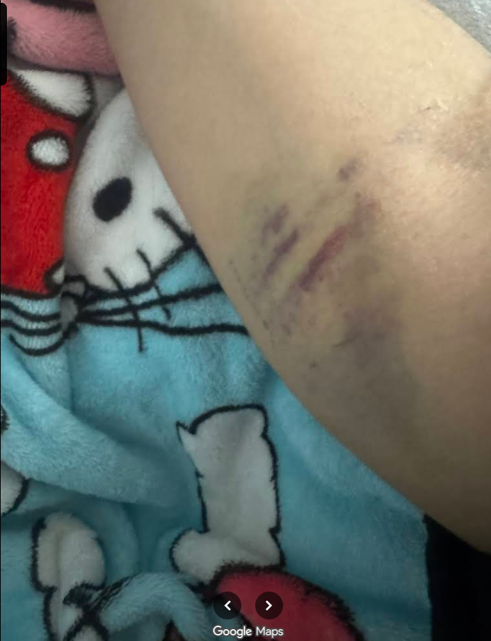 Sunrise Hospital, photo of Patient-184's damaged arm due to bad placement of IVs Sunrise Hospital, photo of Patient-184's damaged arm due to bad placement of IVs