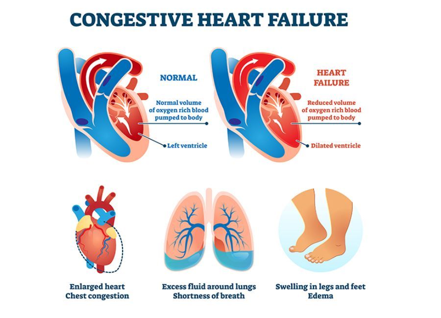 Sunrise Hospital, Patient-293, congestive heart failure, BNP of 702.