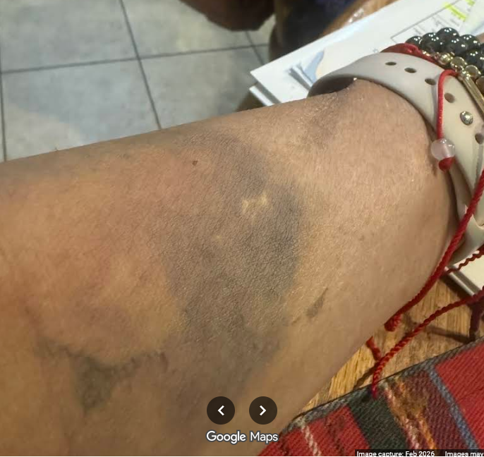 Sunrise Hospital, Patient-297, another horrible IV placement with extensive bruising still visible a week later.