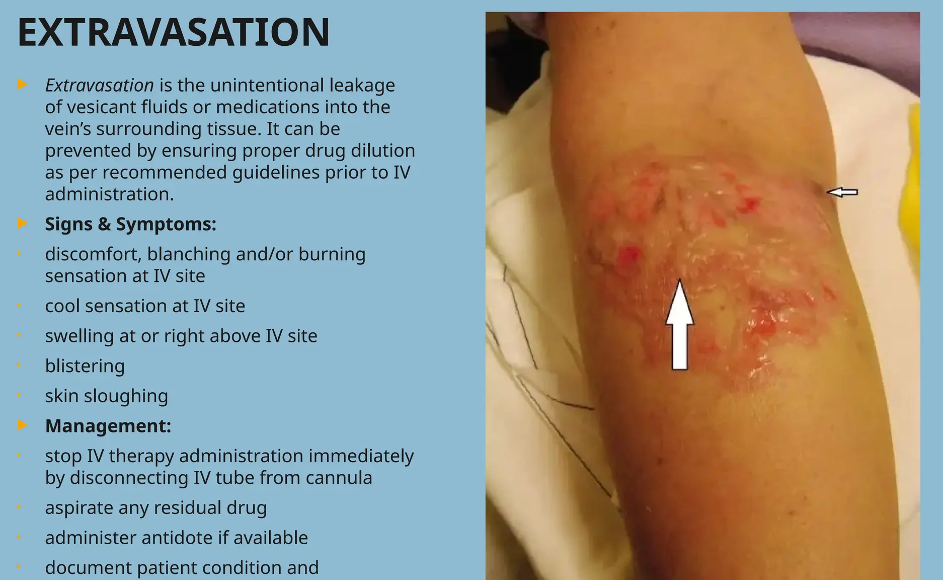 Sunrise Hospital, Patient-300, stock photo of extravasation injury.