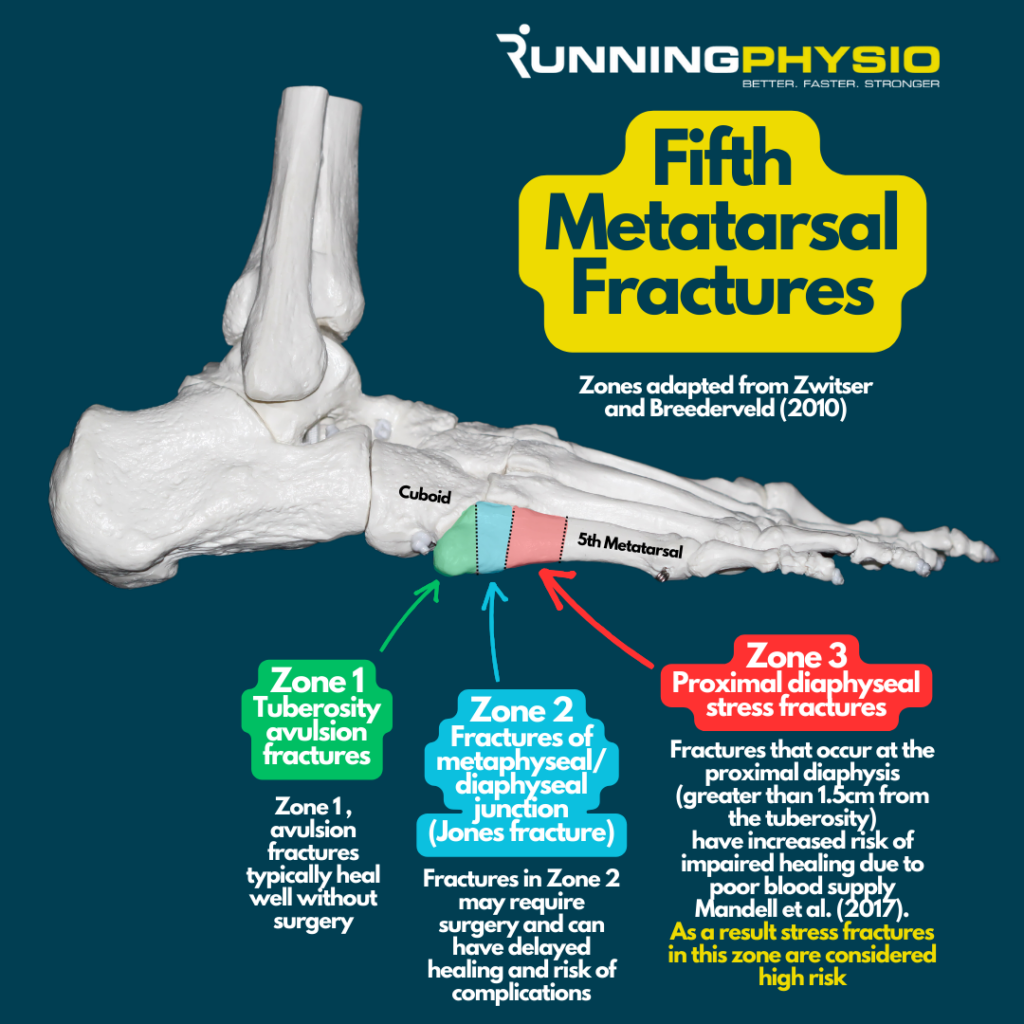 Nevada Orthopedic, Dr. Michael Rossidis, Patient-311, why are fifth metatarsal stress fractures high risk.