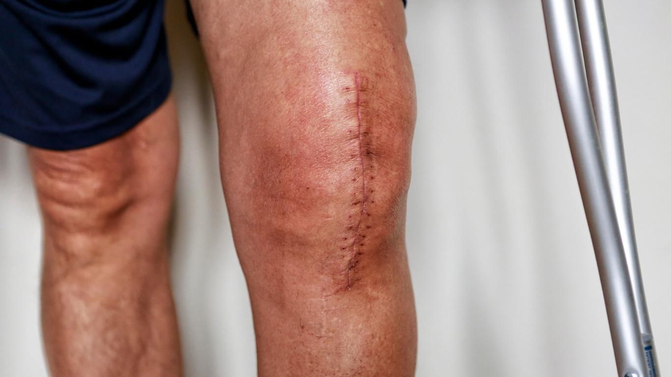 Nevada Orthopedic, Dr. Michael Bradford, Patient-313, stock photo of patient who had knee replacement surgery.