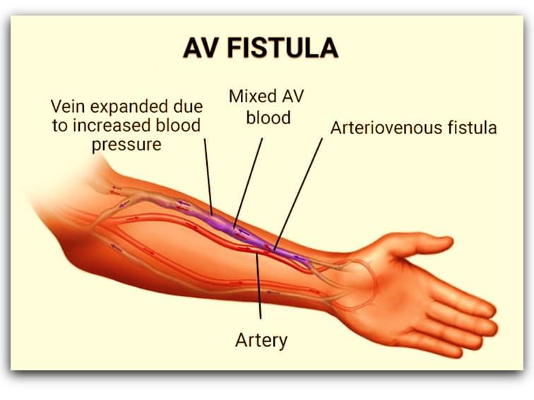 Sunrise Hospital, Patient-358, diagram of arteriovenous fistula used for dialysis. Sunrise Hospital, Patient-358, diagram of arteriovenous fistula used for dialysis.