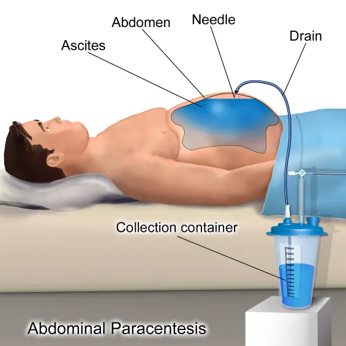 Sunrise Hospital, Patient-389, illustration of draining fluid from the liver. Sunrise Hospital, Patient-389, illustration of draining fluid from the liver.
