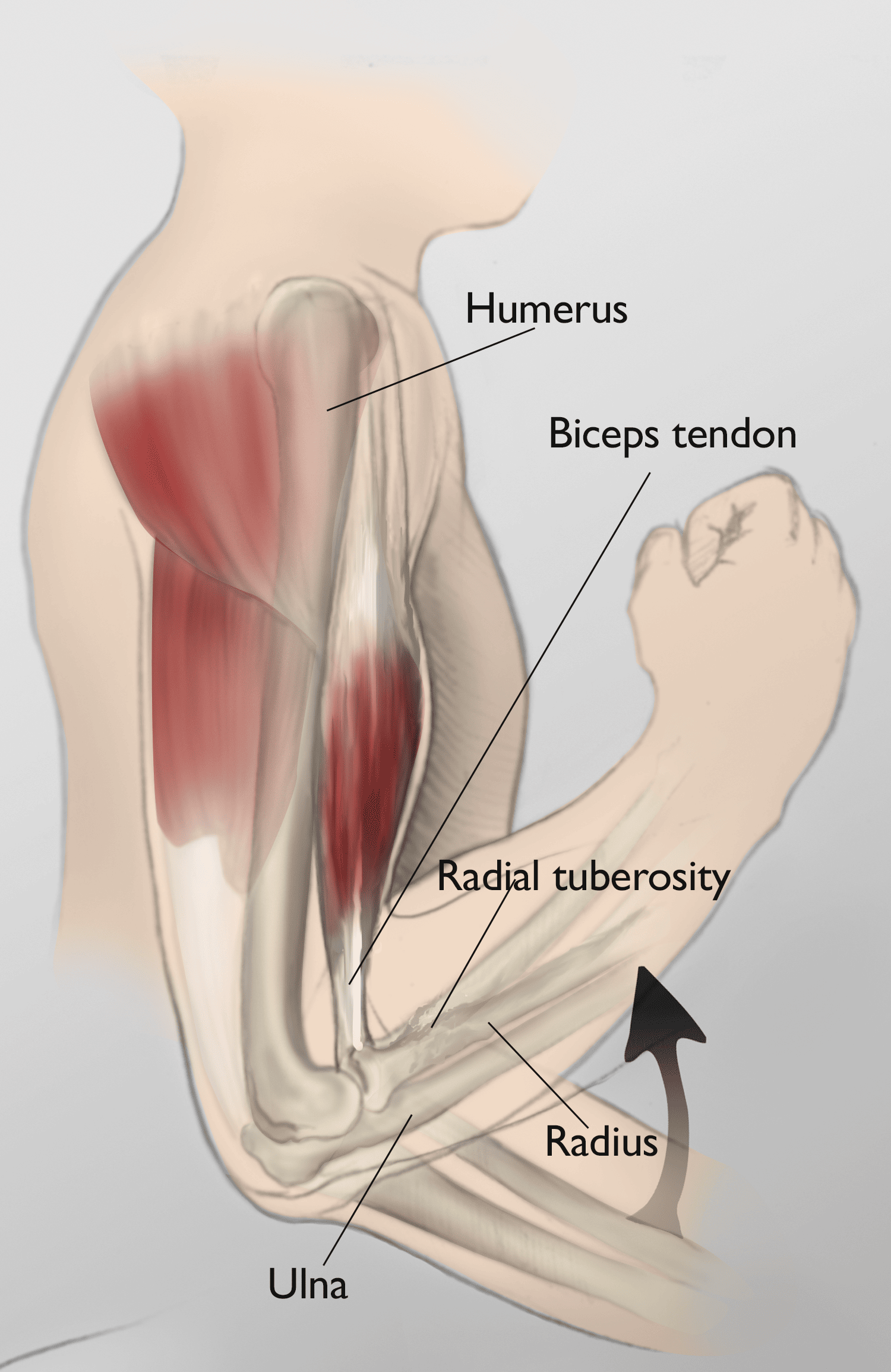 Dr. Kevin Laroche with Nevada Orthopedic, performed biceps tendon repair, but the patient's arm was worse after the surgery Dr. Kevin Laroche with Nevada Orthopedic, performed biceps tendon repair, but the patient's arm was worse after the surgery