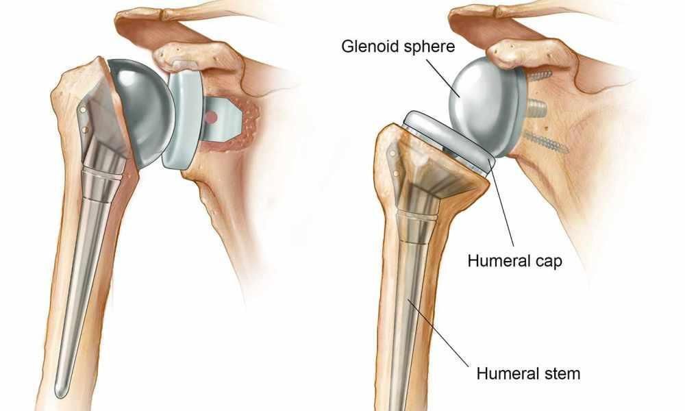 Sunrise Hospital. Another botched shoulder replacement surgery by Dr. Michael Bradford. Sunrise Hospital. Another botched shoulder replacement surgery by Dr. Michael Bradford.