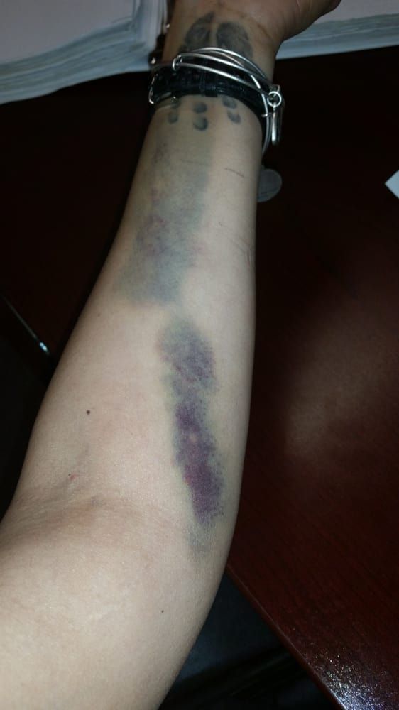 Sunrise Hospital, patient arm damaged by multiple IV attempts