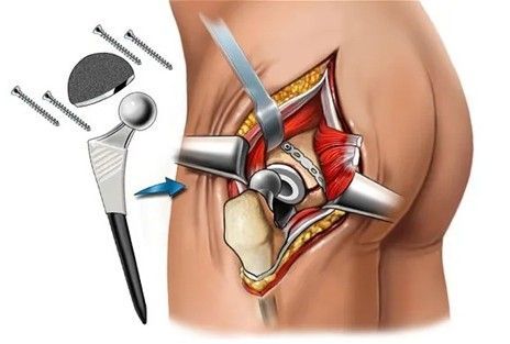 Sunrise Hospital. Patient-15, diagram of hip replacement surgery Sunrise Hospital. Patient-15, diagram of hip replacement surgery