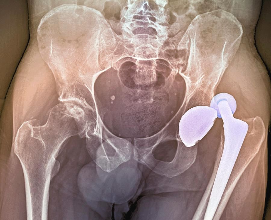 Sunrise Hospital. Patient-16, stock photo of dislocated hip replacement Sunrise Hospital. Patient-16, stock photo of dislocated hip replacement