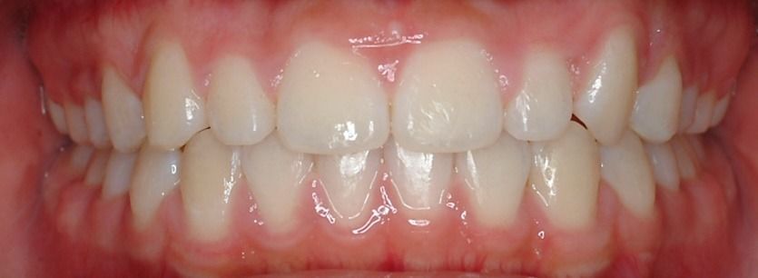 Close-up of a smiling mouth showing upper and lower teeth and pink gums