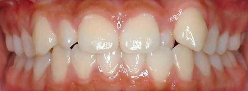 Close-up of a person's teeth and gums with braces removed, showing a smile