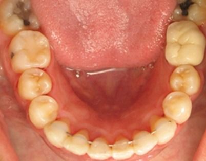 Close-up of lower teeth and gums inside an open mouth, with a tongue visible above.