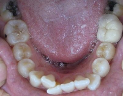 Open mouth showing lower teeth with dental braces and a dark, mottled tongue floor.