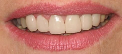 After image of a mouth with a new tooth
