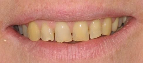 Before image of a mouth that is missing a tooth