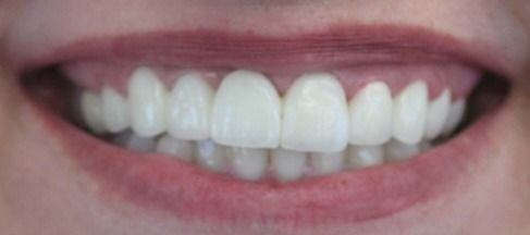 After Image of a mouth with straight teeth and no silver filing