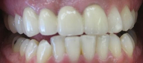 Before  Image of a mouth with crooked teeth and a silver filling 