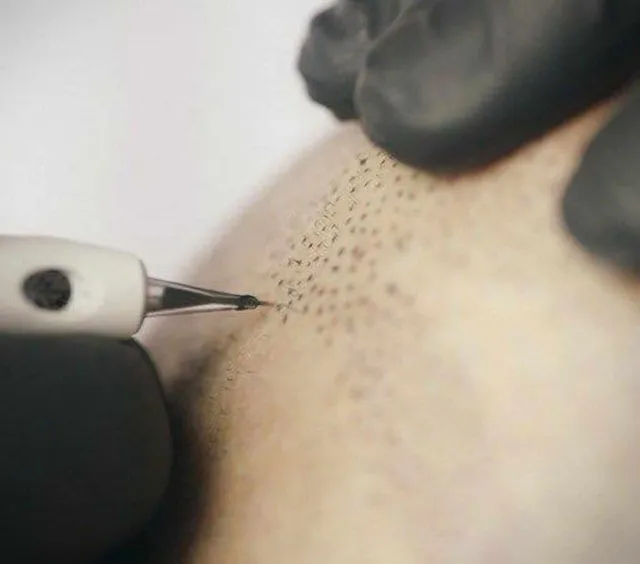 scalp getting SMP treatment