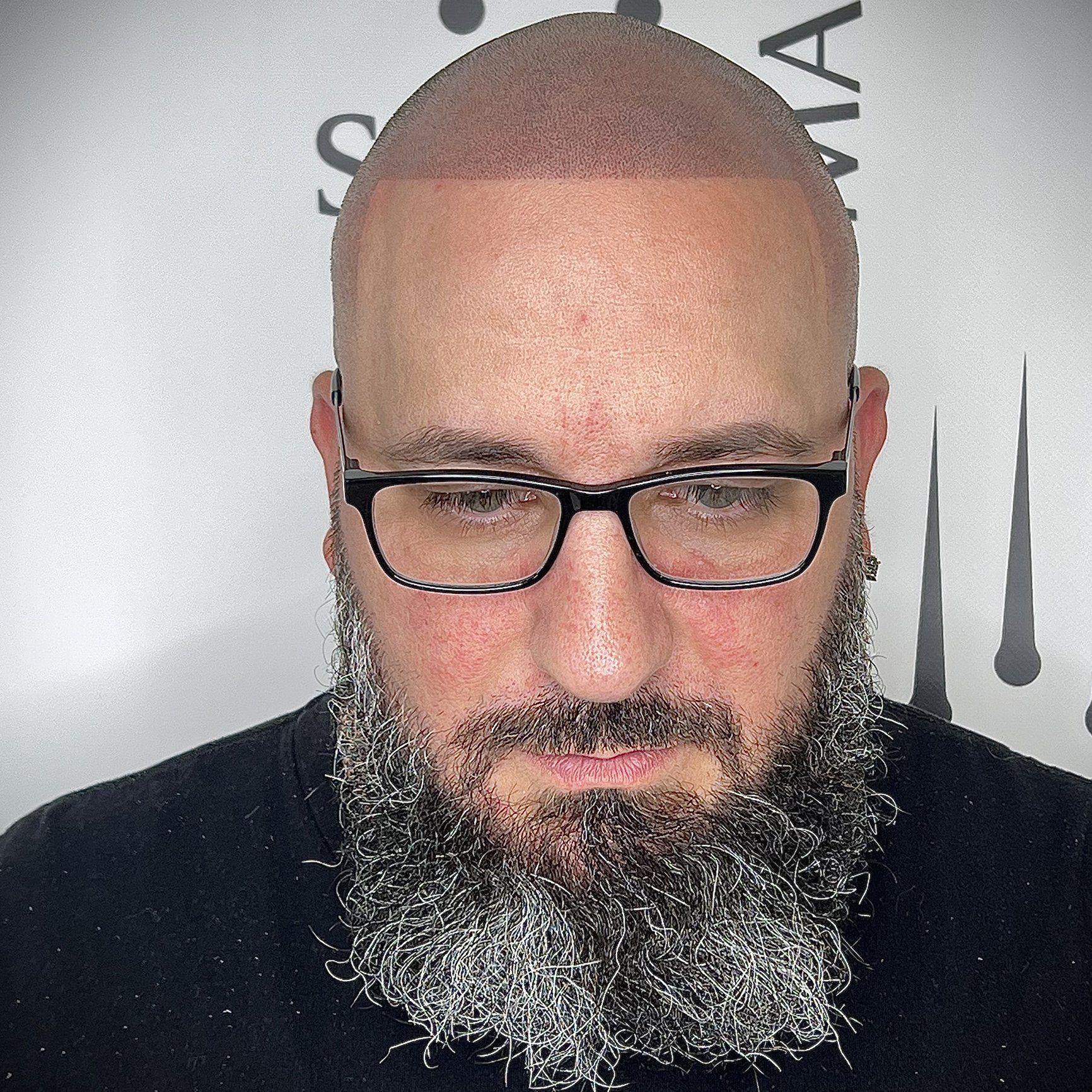 Man with a shaved head and beard, wearing glasses, and a scalp micropigmentation treatment.