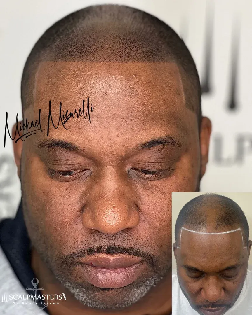 SMP aftercare tips scalp micropigmentation fresh hairline - SMP aftercare tips