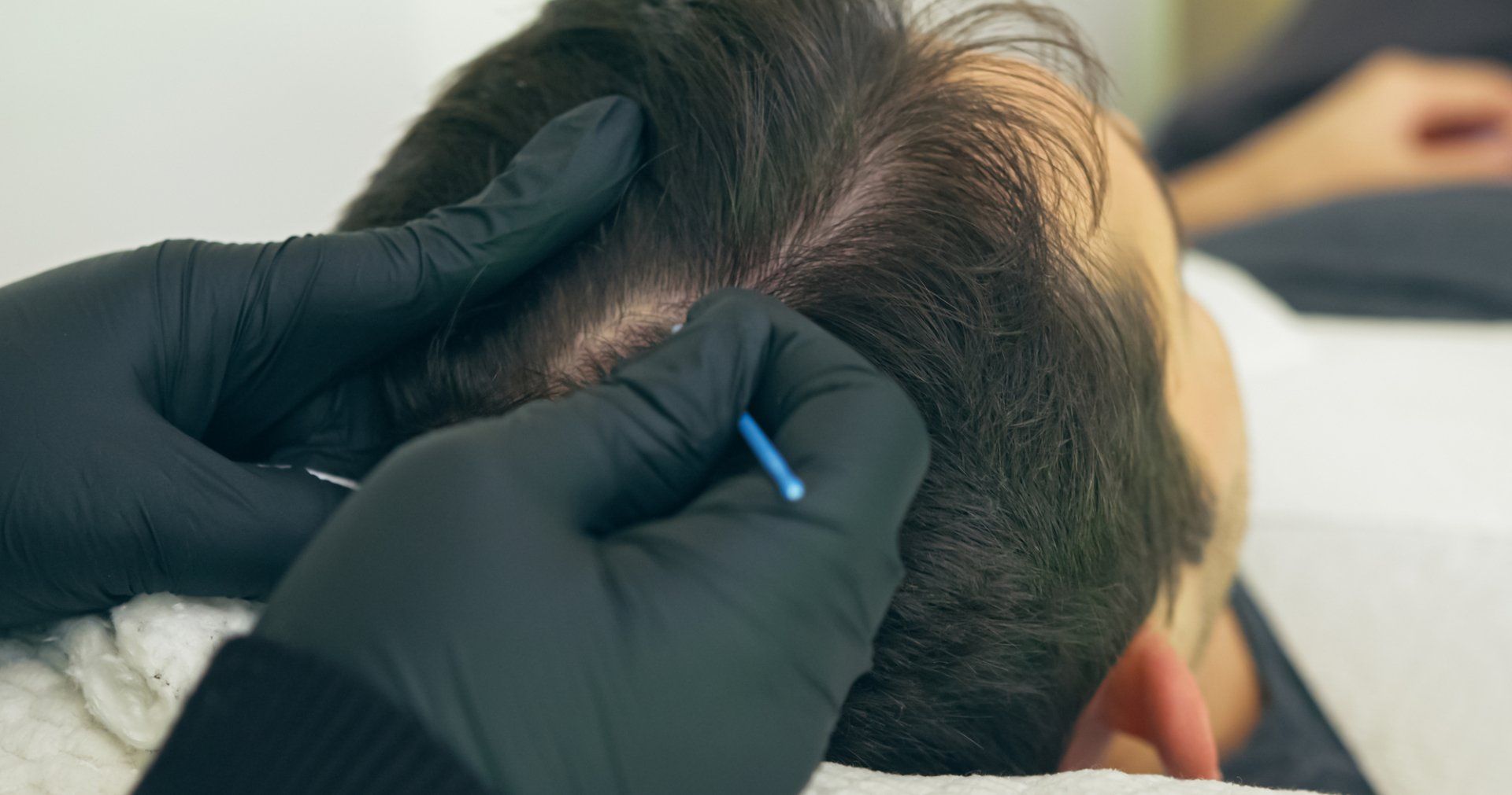 A man is getting an acupuncture treatment in his head.