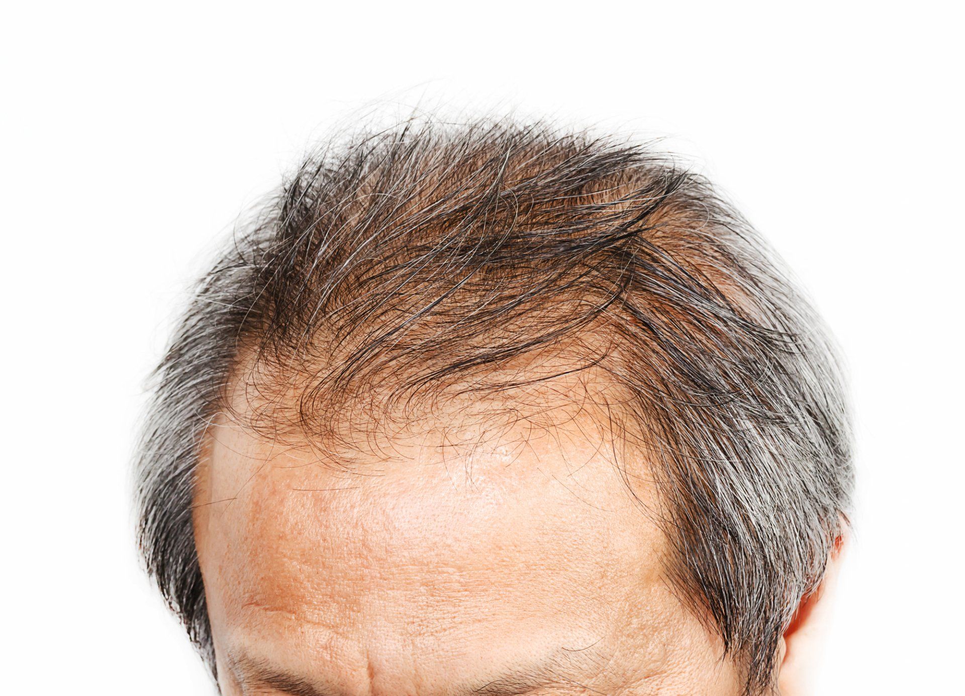 Humira causes hair loss