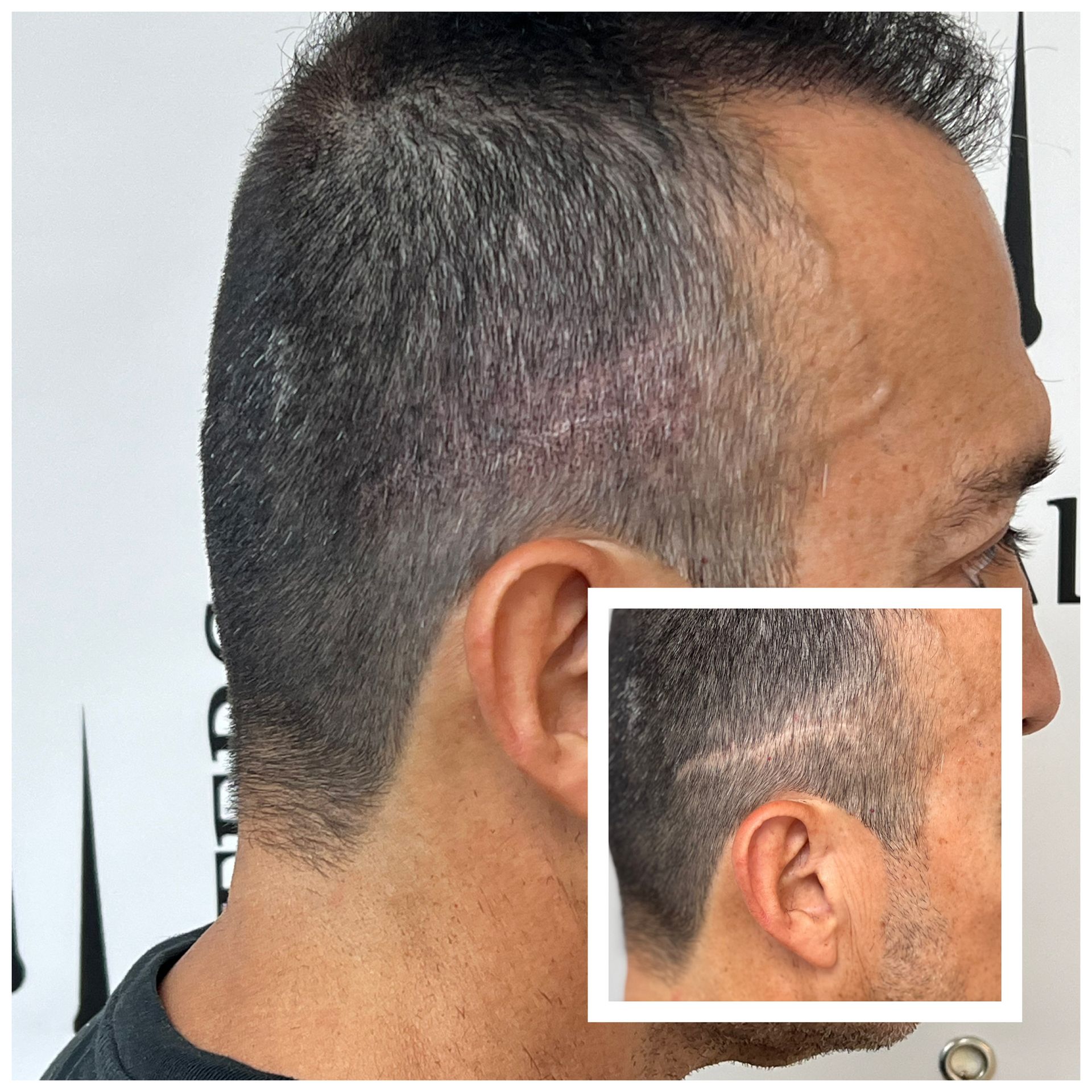 Man's head and neck profile. He has a scar on his scalp. A smaller, inset image shows the scar.