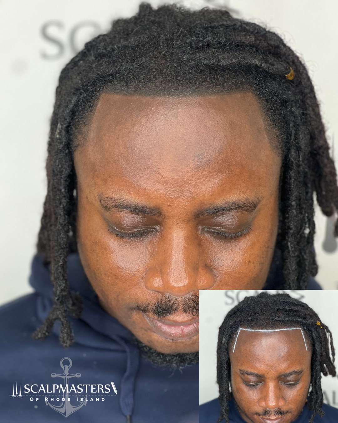 Hairloss