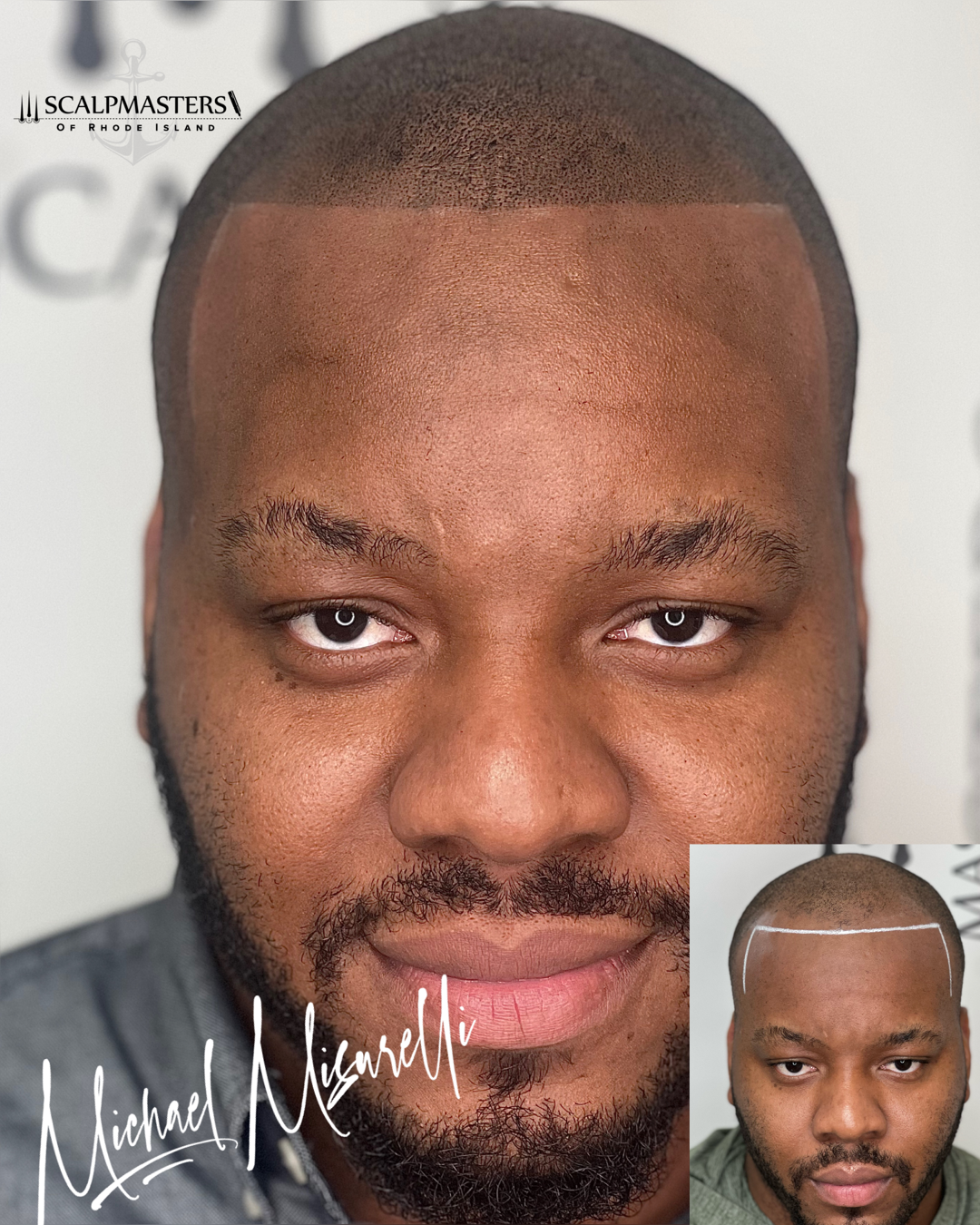 Hairloss