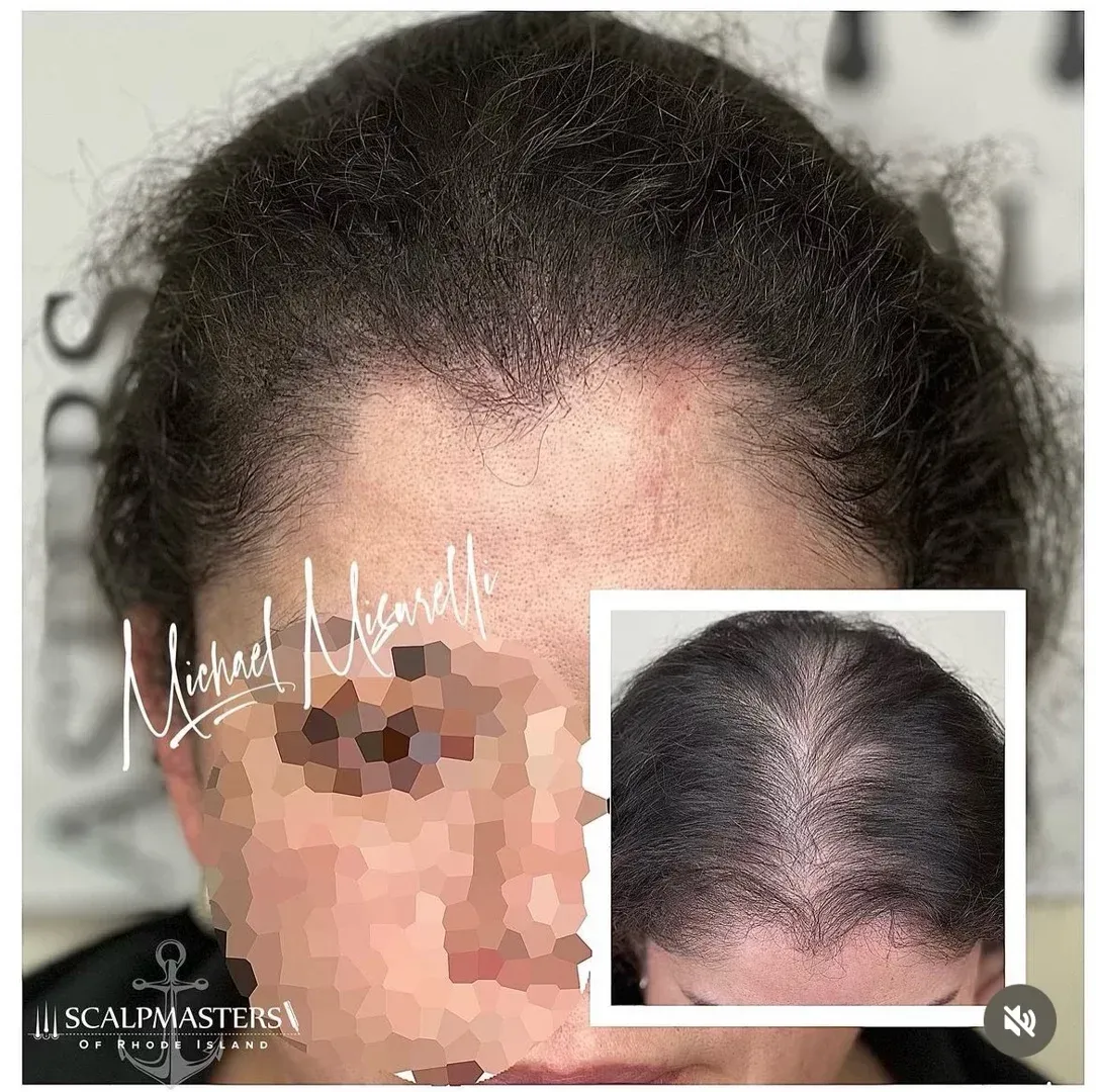 scalp pigmentation treatment