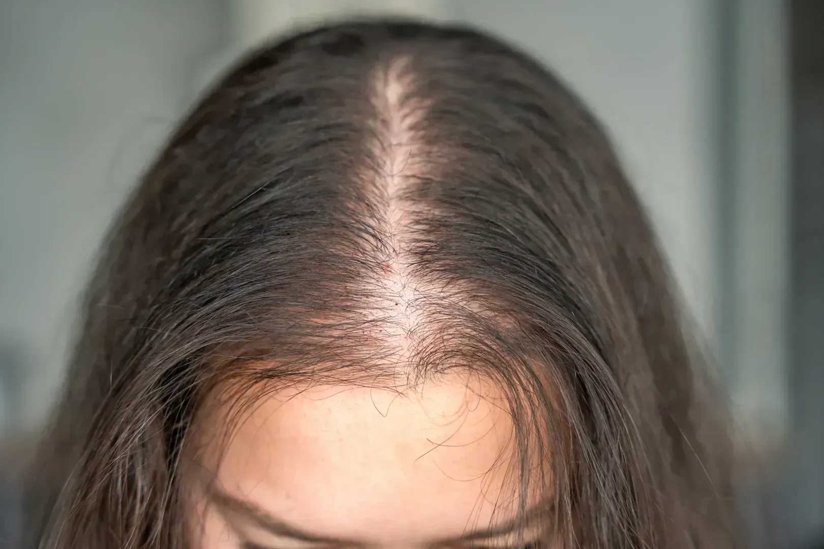 hair loss clinic Boston consultation