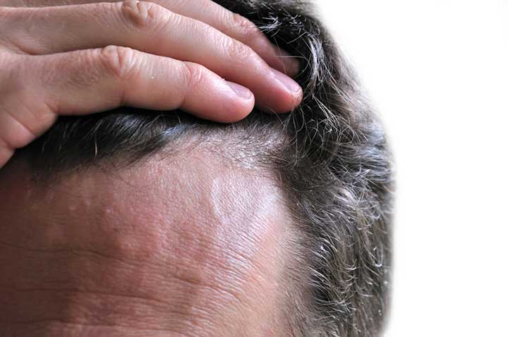 uneven hairline causes