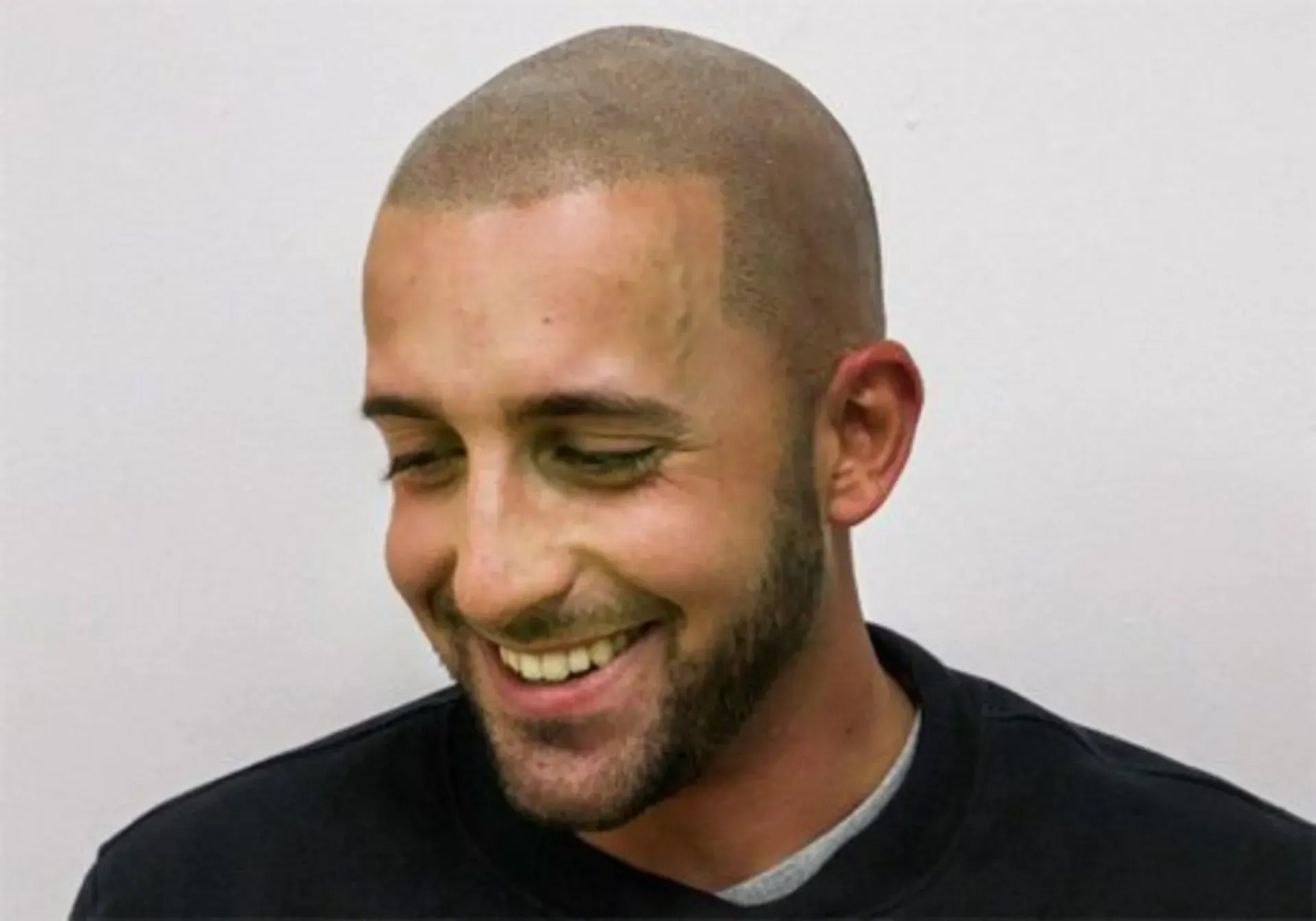 SMP hair tattoo scalp micropigmentation transformation