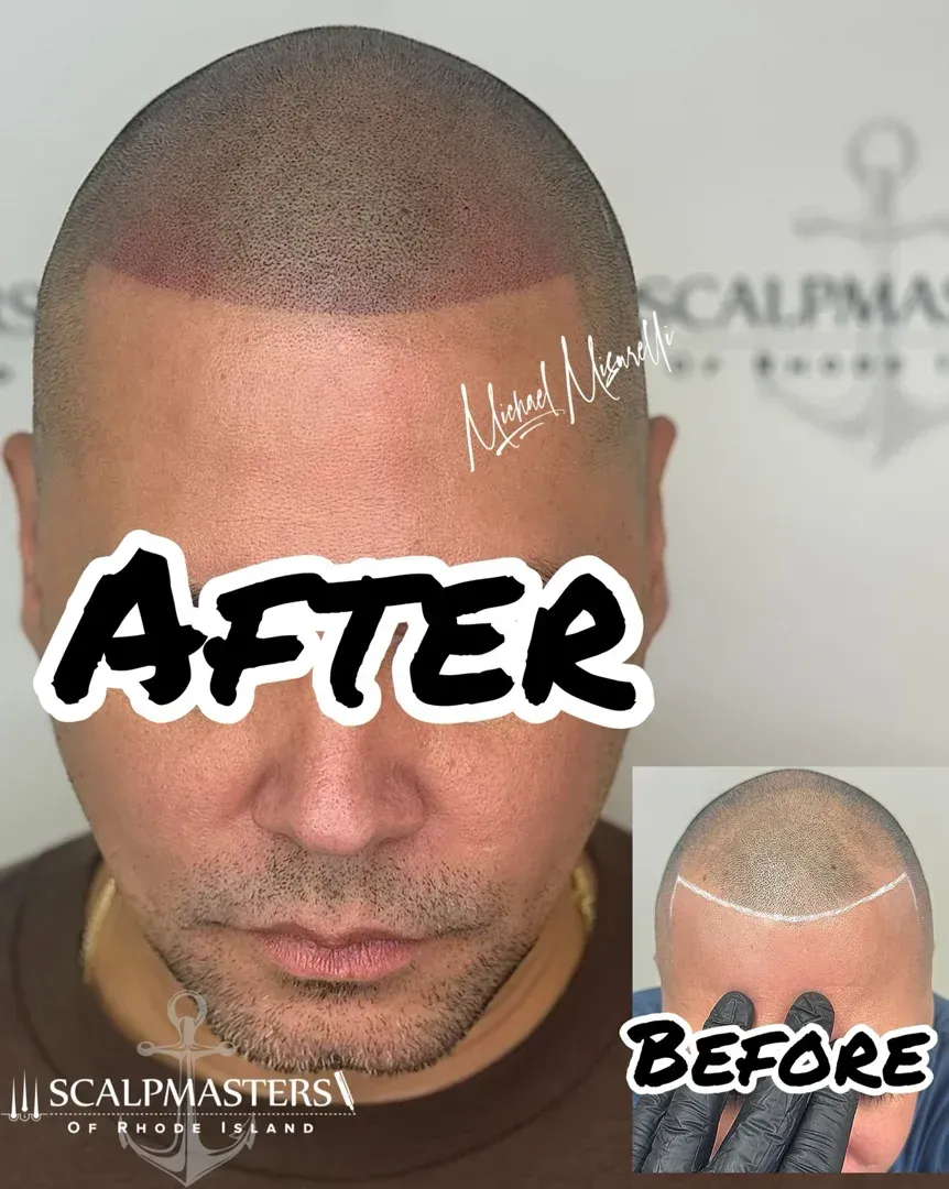 Scalp micropigmentation before-and-after close-up with