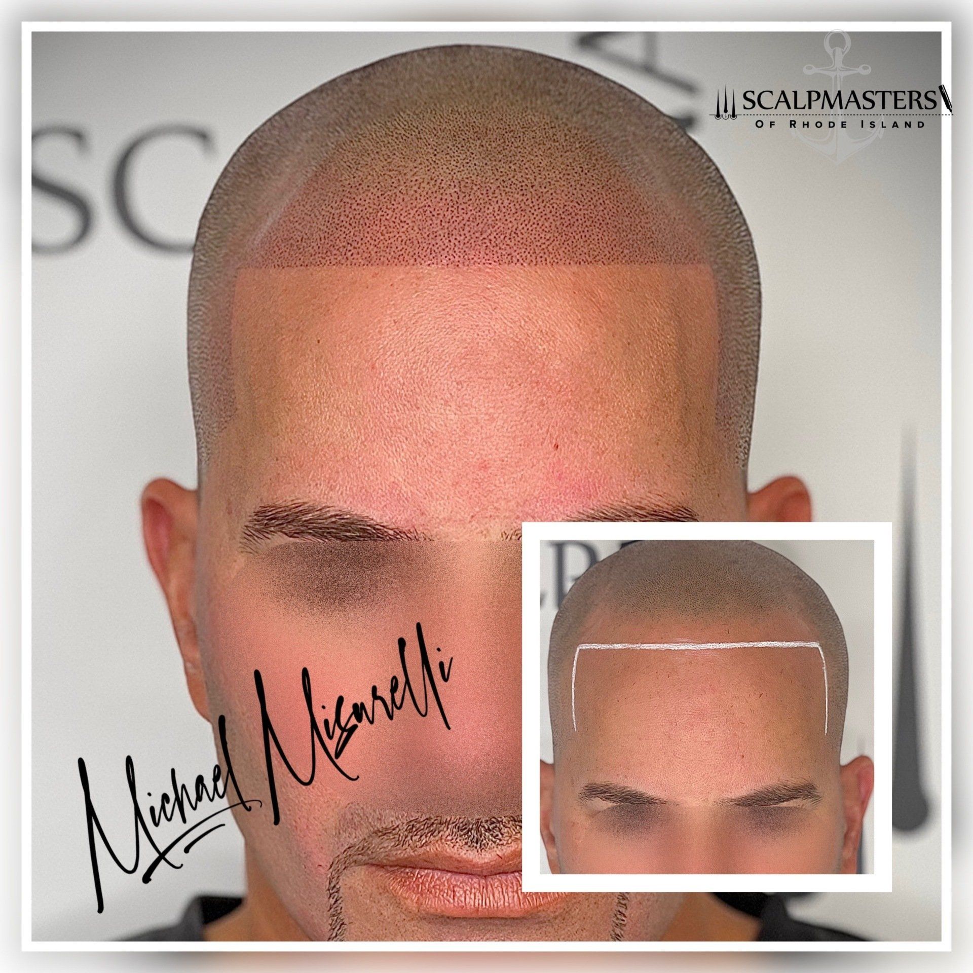 Scalp micropigmentation procedure on a man's head, showing hairline design and completed work.