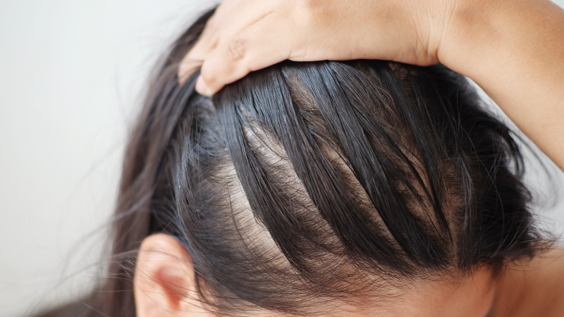 women hair loss