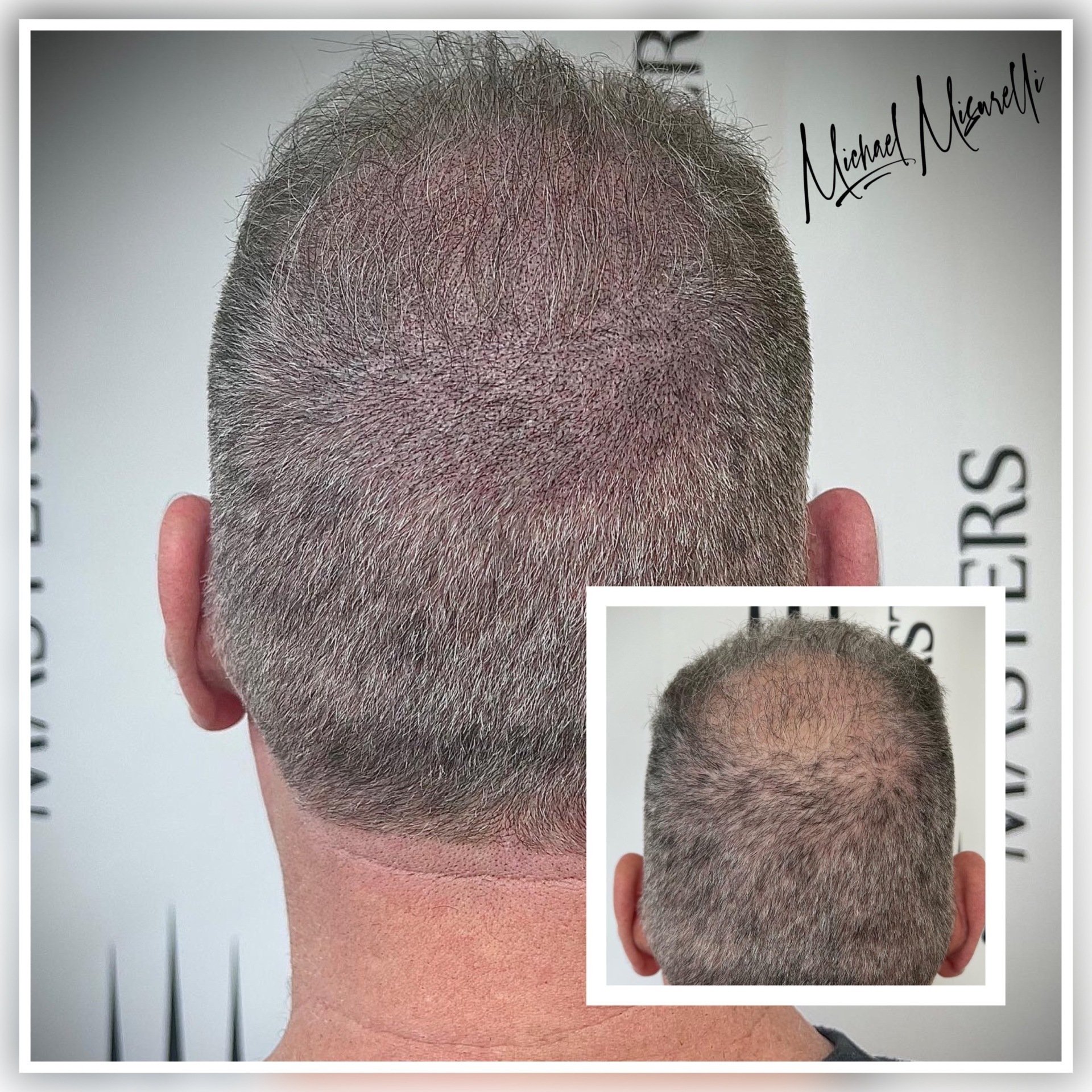 Hairloss