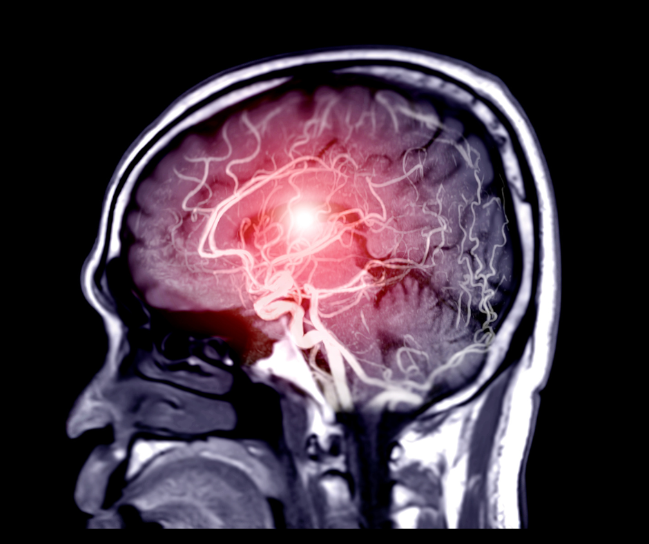 glutathione for herniated discs Bioactive Therapies Degenerative Disc Disease: Microenvironmental Foundations of Disease Dietary integration with galactose, coenzyme
