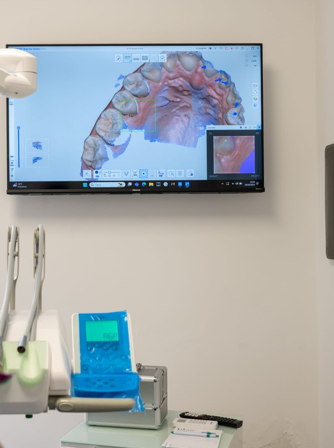 Una scansione dentale digitale della mascella superiore di un paziente visualizzata su un monitor a parete in una sala visite odontoiatrica.