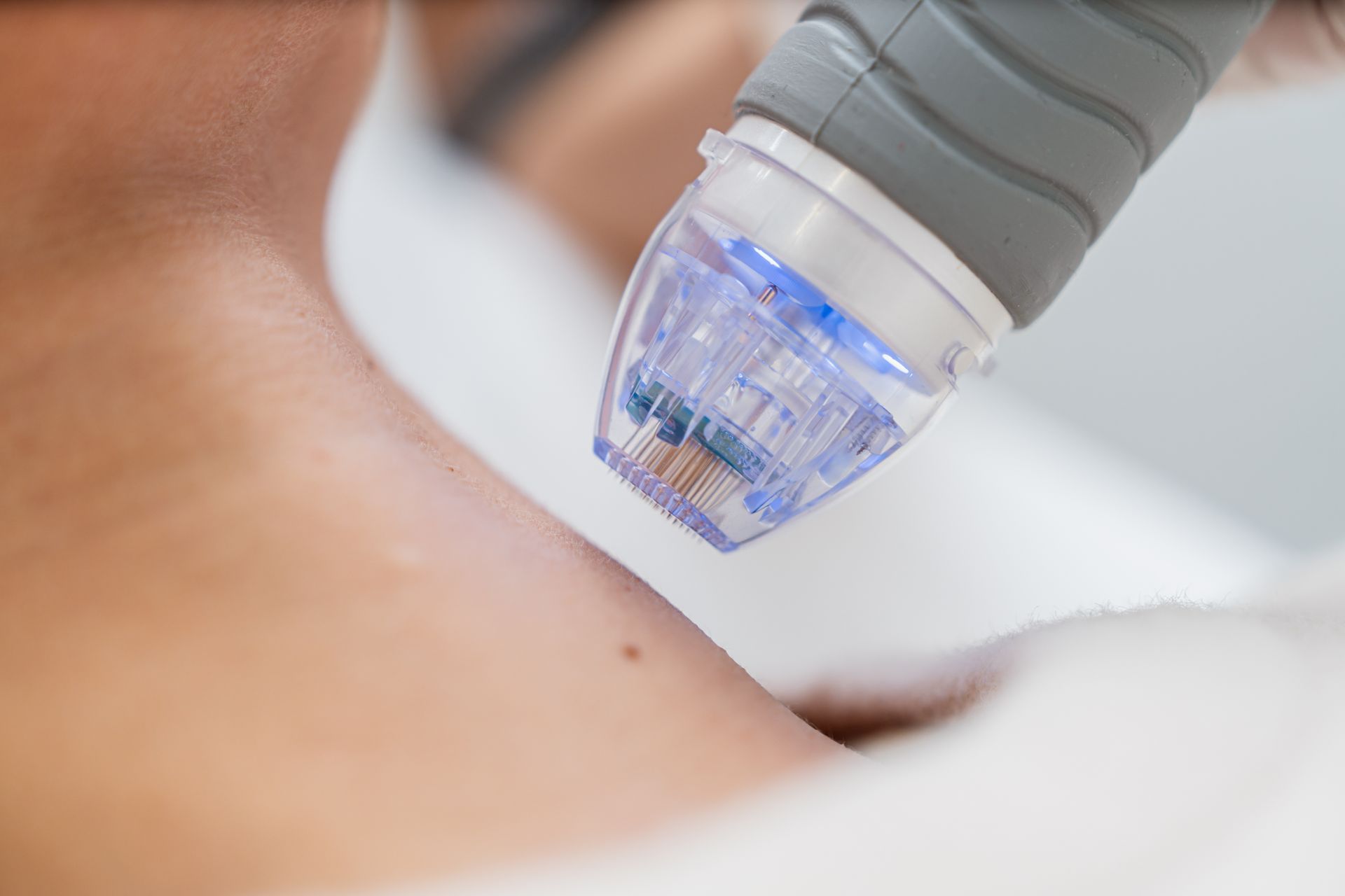 Microneedling device treating skin on a person’s neck or shoulder