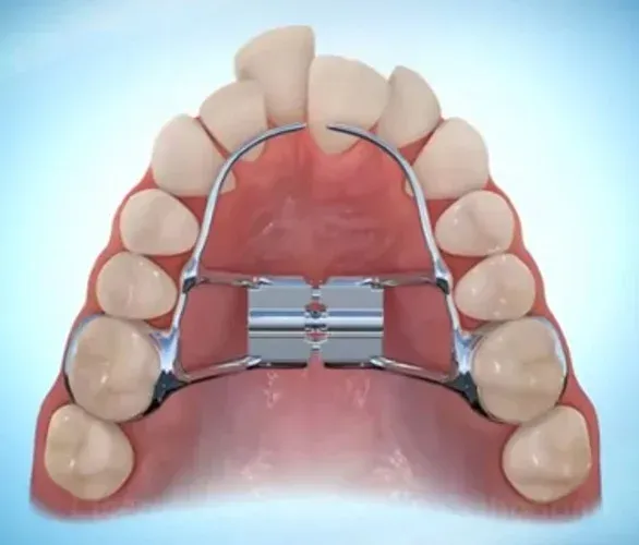 Dental appliance (palatal expander) in mouth, used to widen the upper jaw.