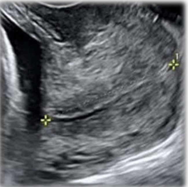 ecografia transvaginale